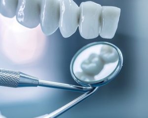 What Are the Benefits of Porcelain Veneers in Cosmetic Dentistry?