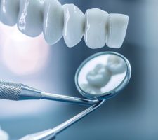 What Are the Benefits of Porcelain Veneers in Cosmetic Dentistry?