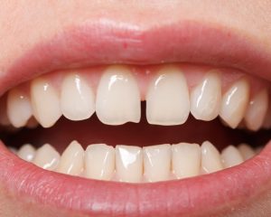 How Does Cosmetic Dentistry Address Gaps Between Teeth?