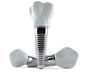 Top Questions to Ask Your Dentist Before Getting Dental Implants Top Questions to Ask Your Dentist Before Getting Dental Implants